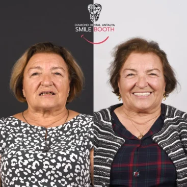 Dental implants Antalya turkey, dental implants before after, Antalya dental implants, turkey dental implant packages, dental implant packages turkey, dental implant prices turkey