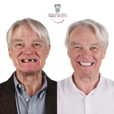 Dental implants Antalya turkey, dental implants before after, Antalya dental implants, turkey dental implant packages, dental implant packages turkey, dental implant prices turkey