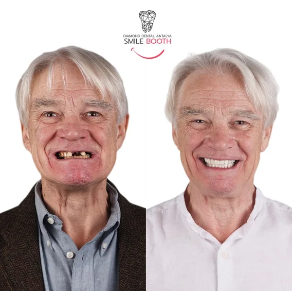 Dental implants Antalya turkey, dental implants before after, Antalya dental implants, turkey dental implant packages, dental implant packages turkey, dental implant prices turkey