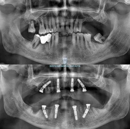 All on 4 dental implant system in Antalya Turkey, best all on 4 dental implant dental clinic