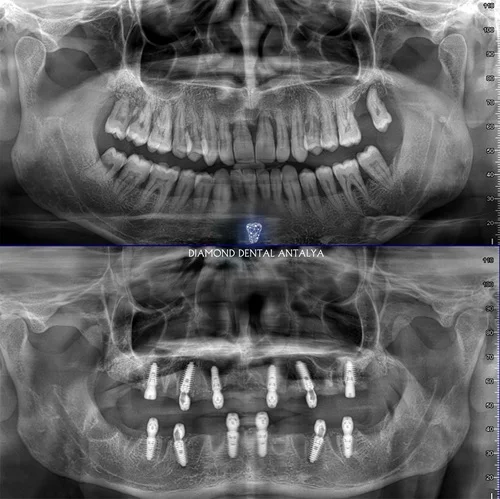 All on 6 dental implant system in Antalya Turkey, best all on 6 dental implant dental clinic