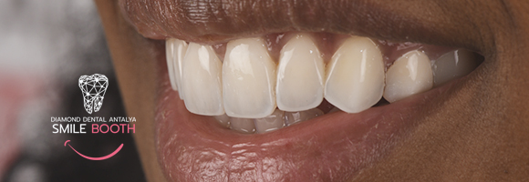 composite bonding turkey antalya, smile design without cutting teeths