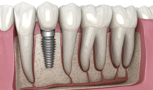 dental implants antalya turkey, dental implant dentist antalya turkey