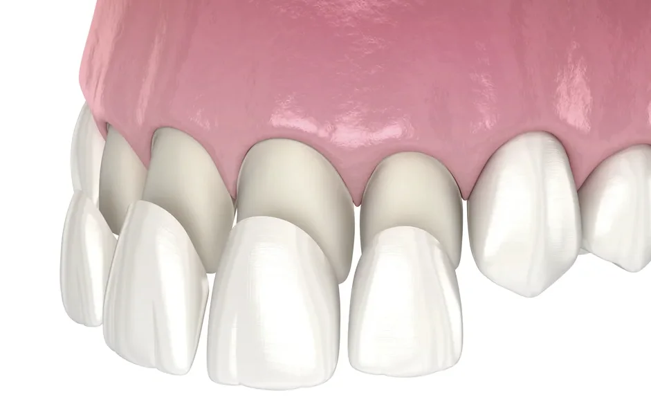 E-max veneers Antalya Turkey