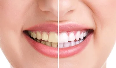 Teeth whitening before after