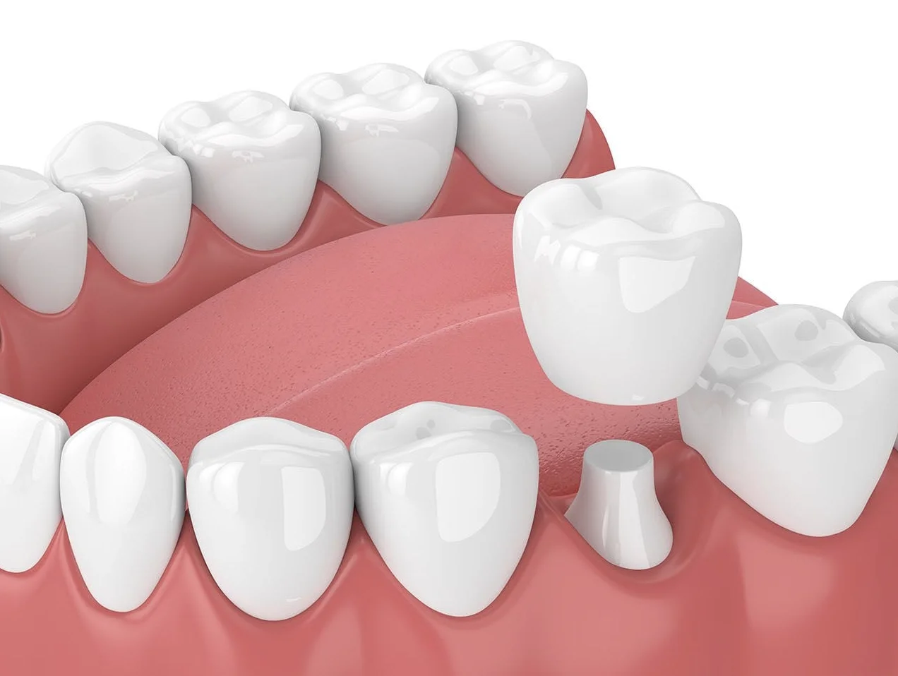 Best dental clinic for zirconium crowns and dental implants
