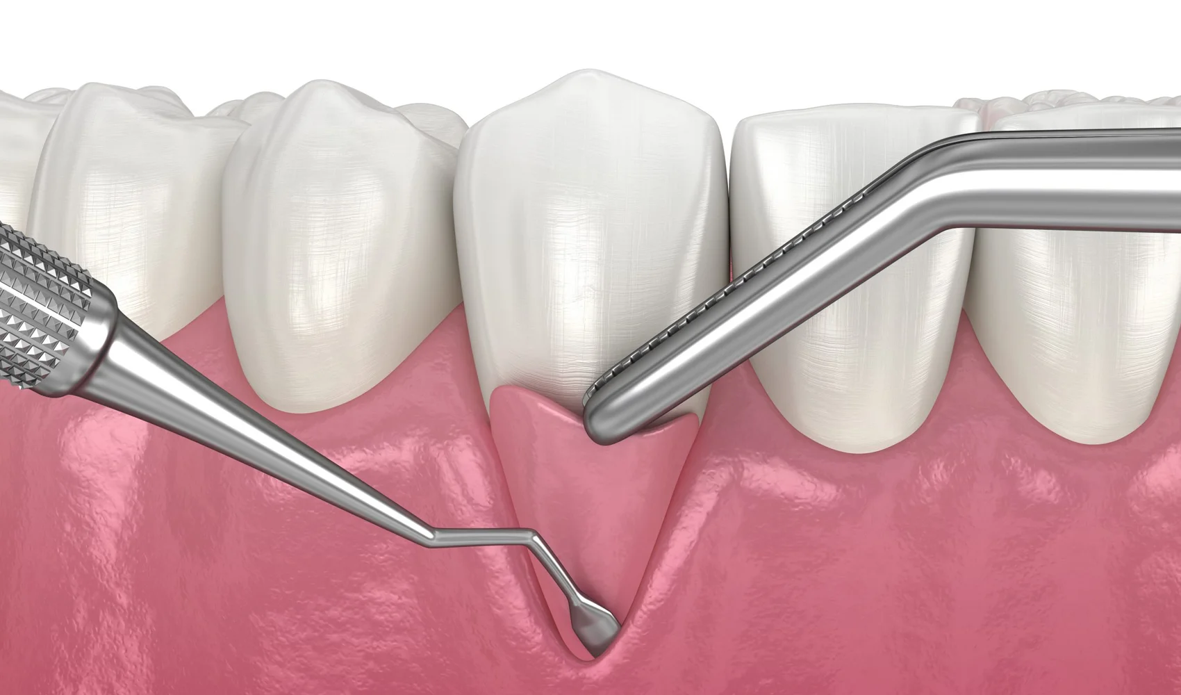 gum grafting antalya turkey, gum cutting antalya, gum disease
