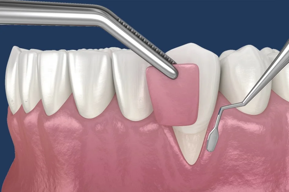 gum grafting antalya turkey, gum cutting antalya, gum disease