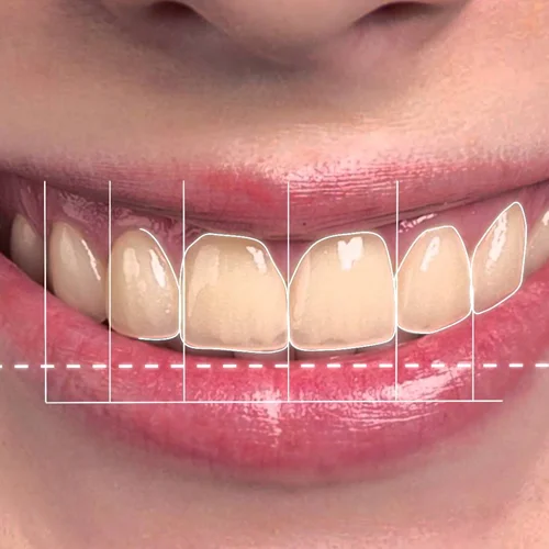 hollywood smile turkey antalya, smile makeover antalya, smile makeover turkey