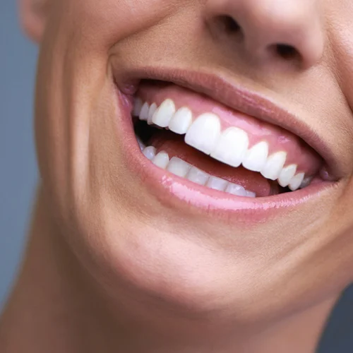 hollywood smile turkey antalya, smile makeover antalya, smile makeover turkey