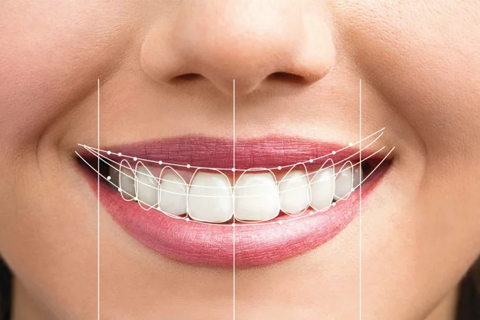 hollywood smile turkey antalya, smile makeover antalya, smile makeover turkey