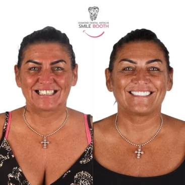 zirconium crowns turkey, zirconium crowns antalya