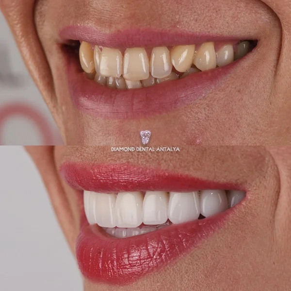 laminate veneers antalya, emax veneers, emax veneers examples, emax veneers before after, antalya emax veneers, emax veneers laminate veneers