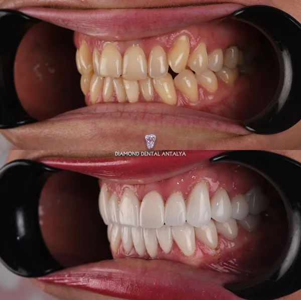 laminate veneers antalya, emax veneers, emax veneers examples, emax veneers before after, antalya emax veneers, emax veneers laminate veneers