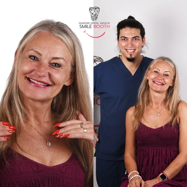 laminate veneers antalya, emax veneers, emax veneers examples, emax veneers before after, antalya emax veneers, emax veneers laminate veneers