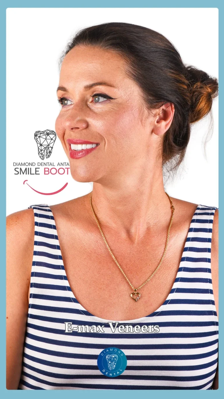 E-max Veneers Antalya Turkey