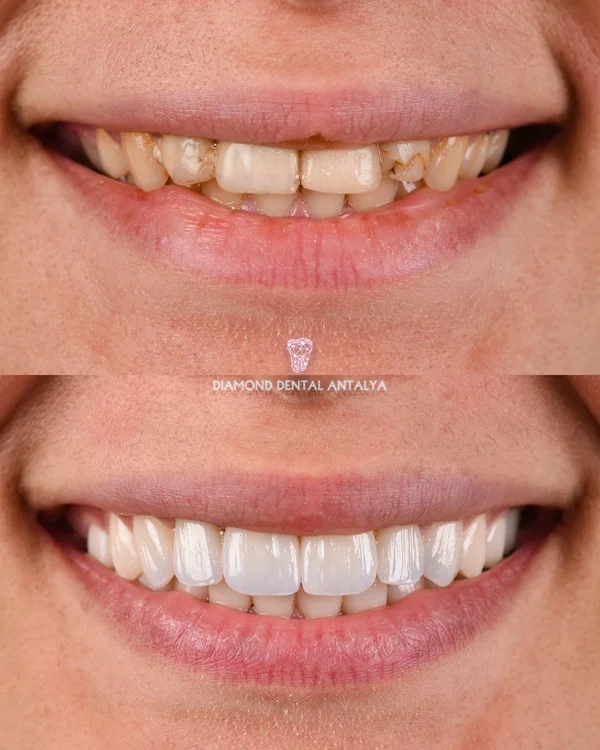 28 zirconium crowns, zirconium crowns, smile makeover, dental treatment, crowns before after