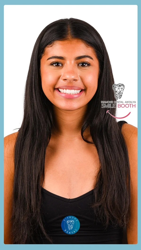 teeth whitening antalya turkey, laser bleaching antalya turkey, philips zoom antalya turkey