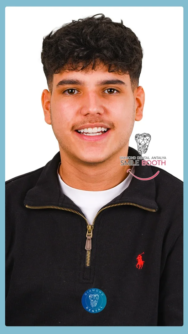teeth whitening antalya turkey, laser bleaching antalya turkey, philips zoom antalya turkey