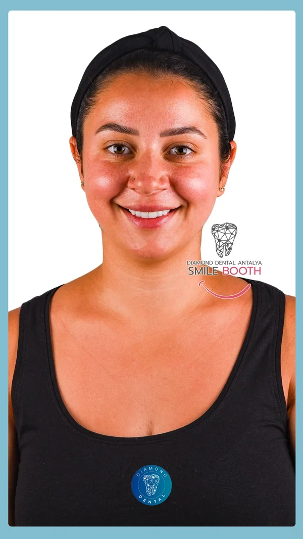 teeth whitening antalya turkey, laser bleaching antalya turkey, philips zoom antalya turkey