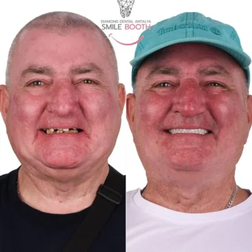 9 Dental Implants and 26 Zirconium Crowns in Antalya Turkey