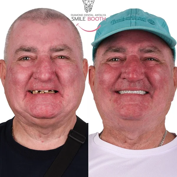 9 Dental Implants and 26 Zirconium Crowns in Antalya Turkey