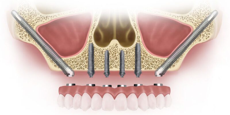 zygomatic dental implants antalya turkey, antalya turkiye zigomatic implants