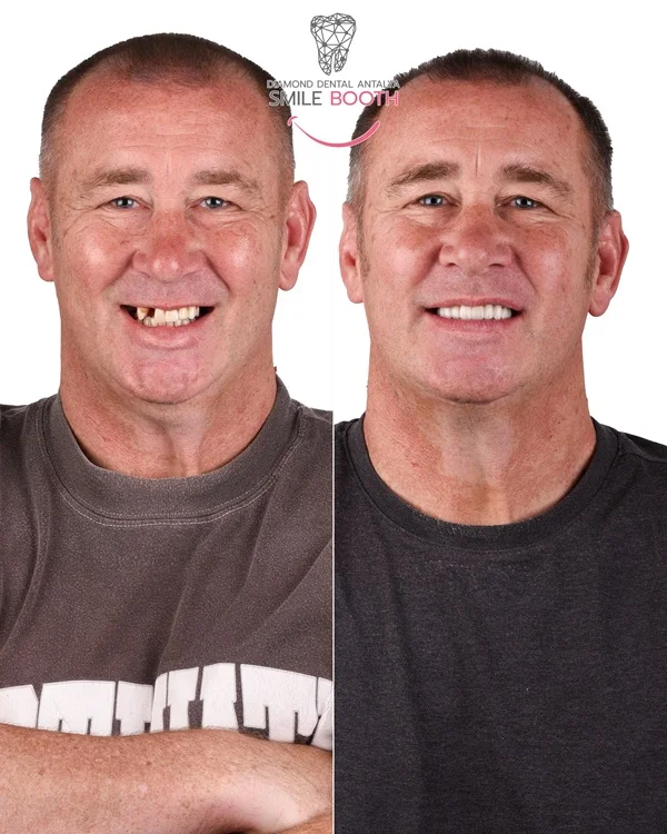 Dental Implants Turkey Before After Photos, dental implants antalya, zirconium crowns antalya turkey