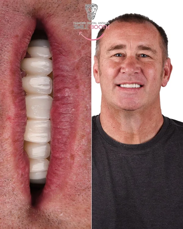 Dental Implants Turkey Before After Photos, dental implants antalya, zirconium crowns antalya turkey