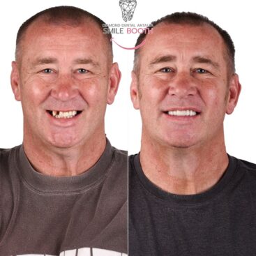 Dental Implants Turkey Before After Photos, dental implants antalya, zirconium crowns antalya turkey
