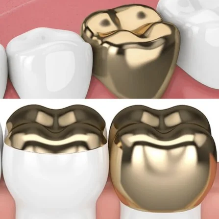 Gold Crowns Antalya Turkey Prices and Packages