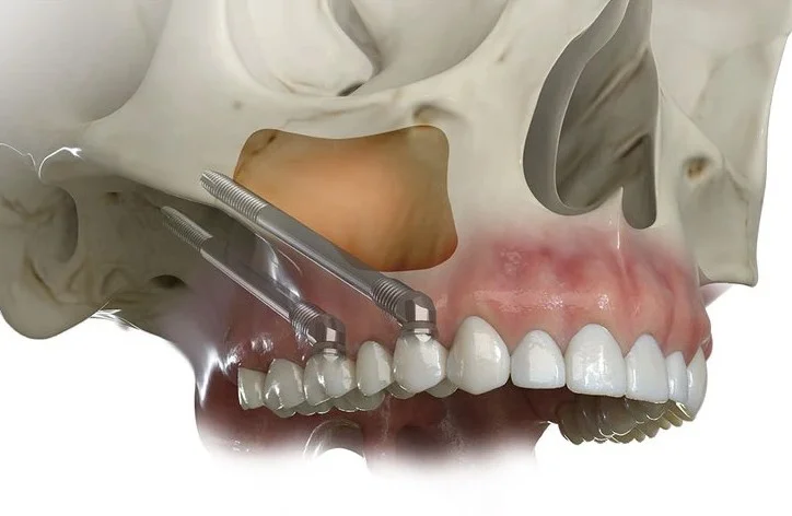 zygomatic dental implants antalya turkey, best dental clinic for zygomatic dental implants