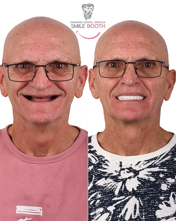 all on 4 dental implant system in turkey antalya, all on 4 prices turkey, all on 4 dental implant costs, all on 4 full mouth treatment prices in turkey