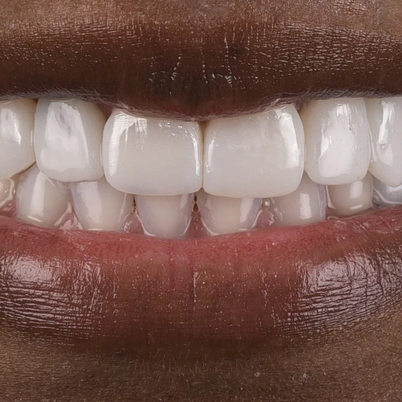 Zirconium Crowns Antalya Turkey Prices and Packages, zirconium crowns turkey antalya prices and packages