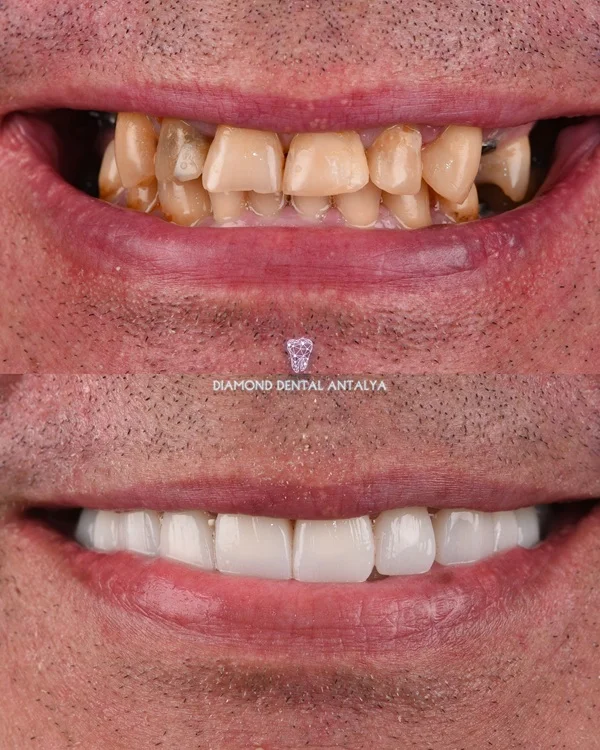 Full-Mouth Restoration at Diamond Dental Antalya Turkey