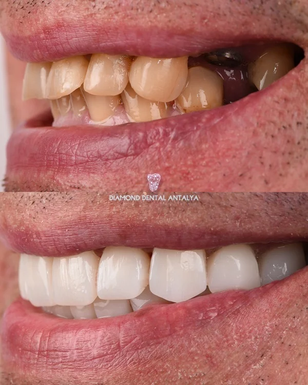Full-Mouth Restoration at Diamond Dental Antalya Turkey