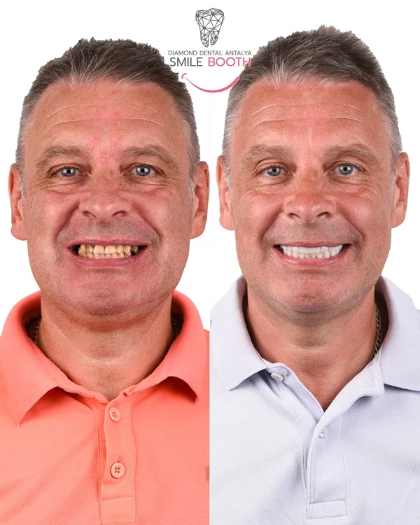 Full-Mouth Restoration at Diamond Dental Antalya Turkey
