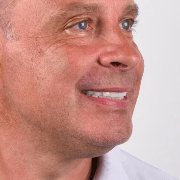 Full-Mouth Restoration at Diamond Dental Antalya Turkey