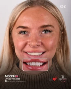 Emax veneers treatment before after results in Turkey Antalya, emax veneers turkey antalya