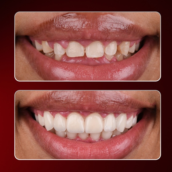 veneers prices turkey, laminate veneers turkey antalya, emax veneers turkey, emax veneers turkey antalya, emax veneers turkey prices, emax veneers prices turkey