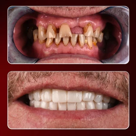 Dental implant prices turkey, Full Mouth Dental implants Turkey, Dental implant brands prices in Turkey, Dental implants costs in Turkey