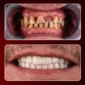 Dental implant prices turkey, Full Mouth Dental implants Turkey, Dental implant brands prices in Turkey, Dental implants costs in Turkey