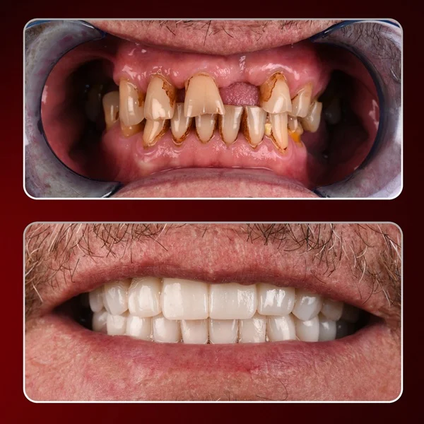 Dental implant prices turkey, Full Mouth Dental implants Turkey, Dental implant brands prices in Turkey, Dental implants costs in Turkey