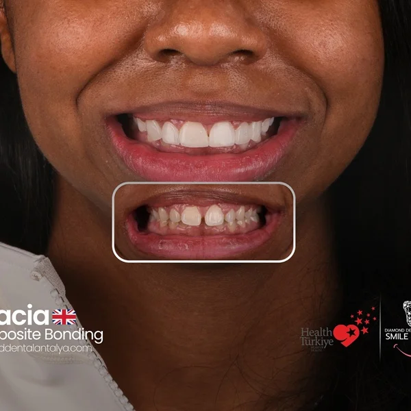 Composite Bondint treatment in Turkey, how long composite bonding treatment, composite bonding price in turkey, composite veneers treatment