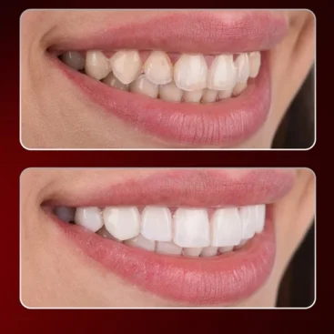 composite bonding turkey antalya, composite bonding prices turkey, composite bonding turkey, non prep veneers turkey antalya