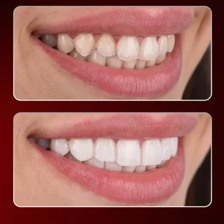 composite bonding turkey antalya, composite bonding prices turkey, composite bonding turkey, non prep veneers turkey antalya