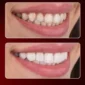 composite bonding turkey antalya, composite bonding prices turkey, composite bonding turkey, non prep veneers turkey antalya