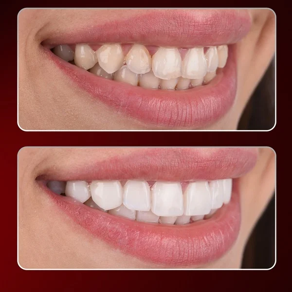 composite bonding turkey antalya, composite bonding prices turkey, composite bonding turkey, non prep veneers turkey antalya