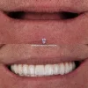 all on 4 dental implant system in turkey antalya, all on 4 prices turkey, all on 4 dental implant costs, all on 4 full mouth treatment prices in turkey