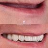 zygomatic dental implants antalya turkey, zygomatic implants turkey, zygomatic implants antalya, zigoma implant
